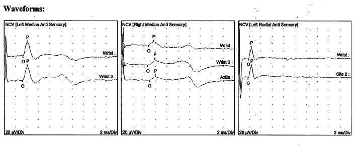 NCS Waveform